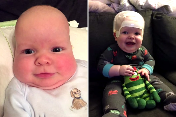 Her Baby Had An Odd Head Shape. Doctors Told Her It Was Because Of This Dangerous Condition.