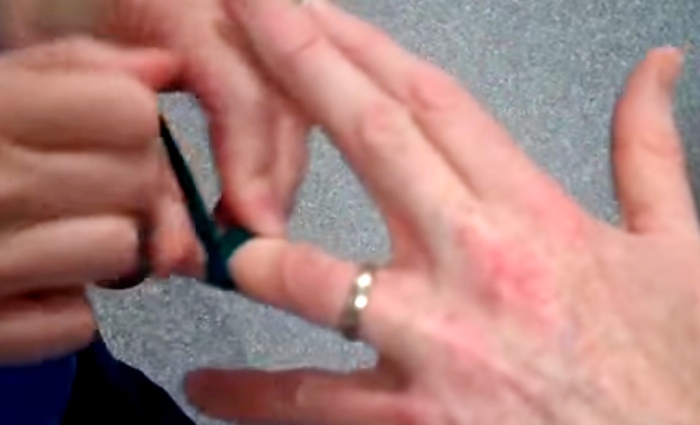 Doctor Shows Us How To Remove A Ring Without Cutting It Off