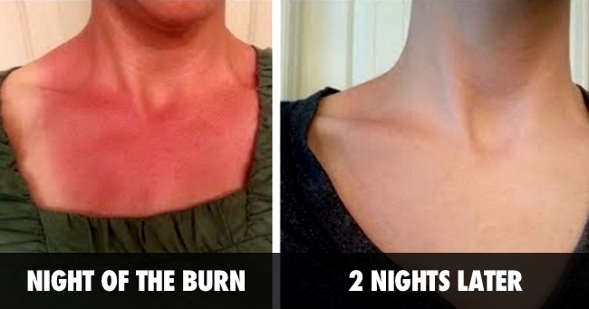 Soothe a Sunburn With These Two Natural Ingredients