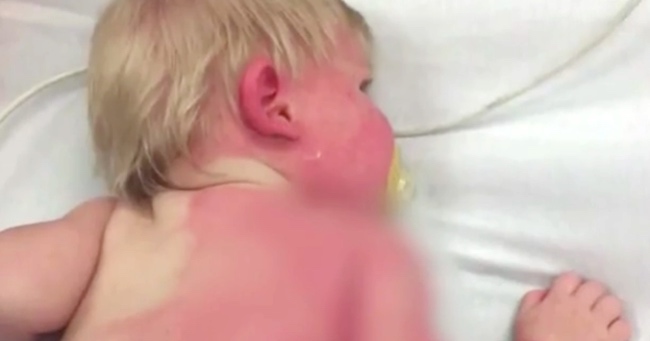 9-Month-Old Baby Receives Second Degree Burns from Water Hose