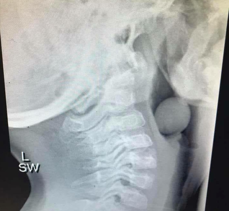 Mom Shares Terrifying Experience of A Child Who Swallowed A Grape