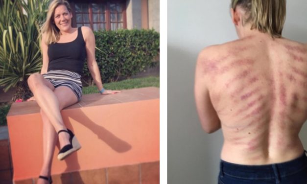 Therapist Shares Photo of Hairdresser’s Back After Massage, Shows Stress on Body