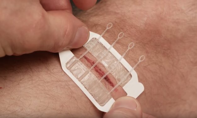 ZipStitch: Treat Your Wounds Without a Hospital